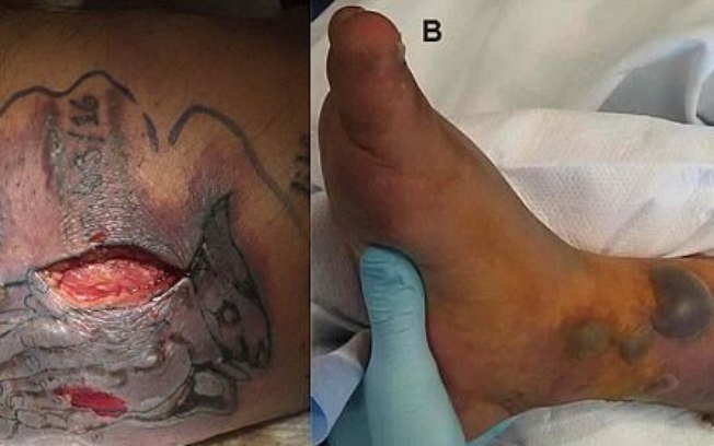 Bactéria já estava "comendo" a pele de homem que tomou banho de mar cinco dias após fazer tatuagem